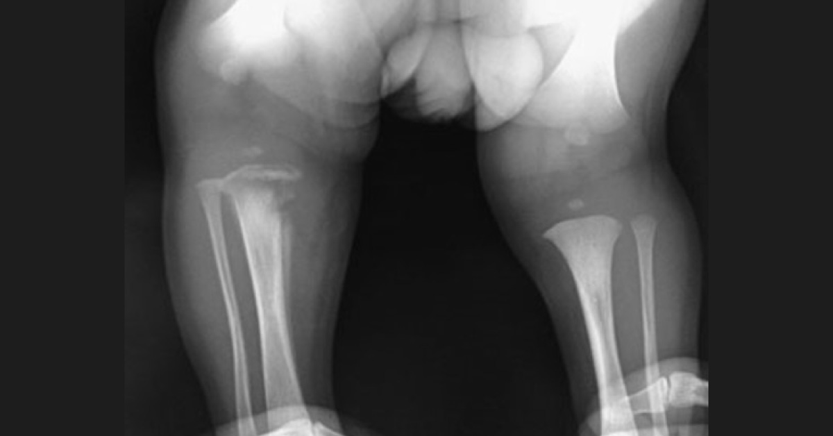 Neonate with a Painful Knee