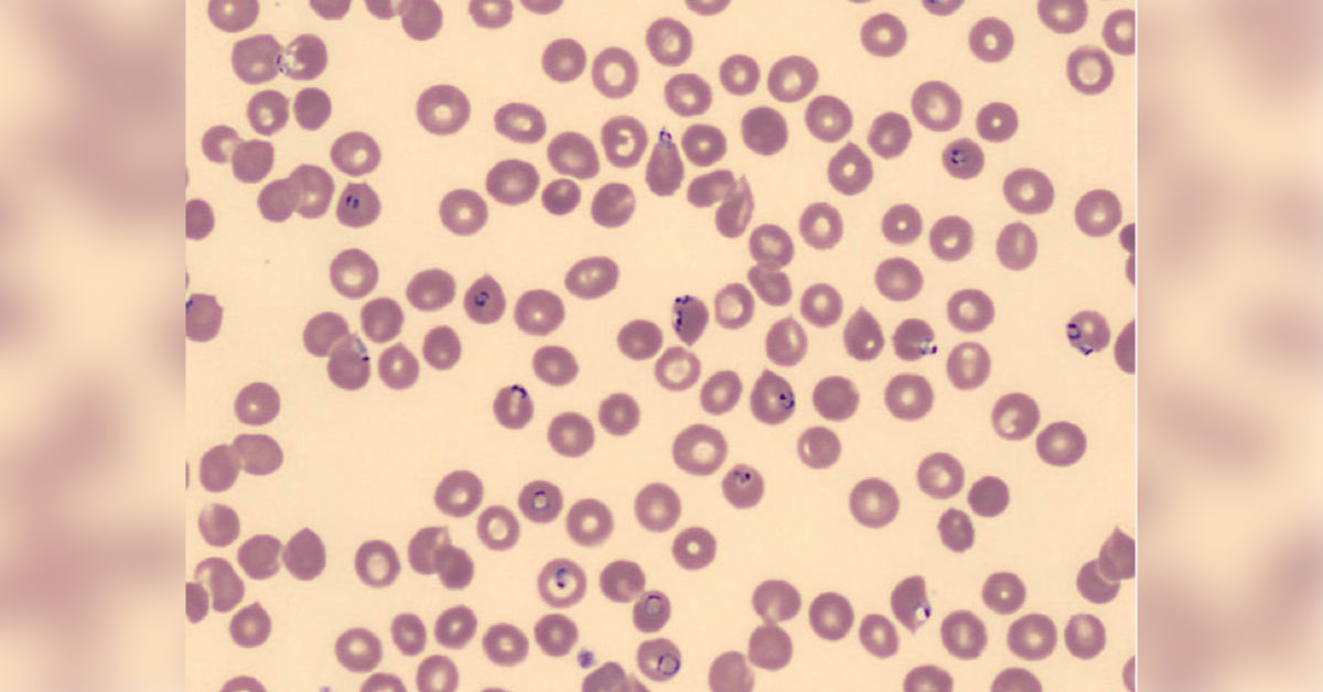 Recurring case of Malaria