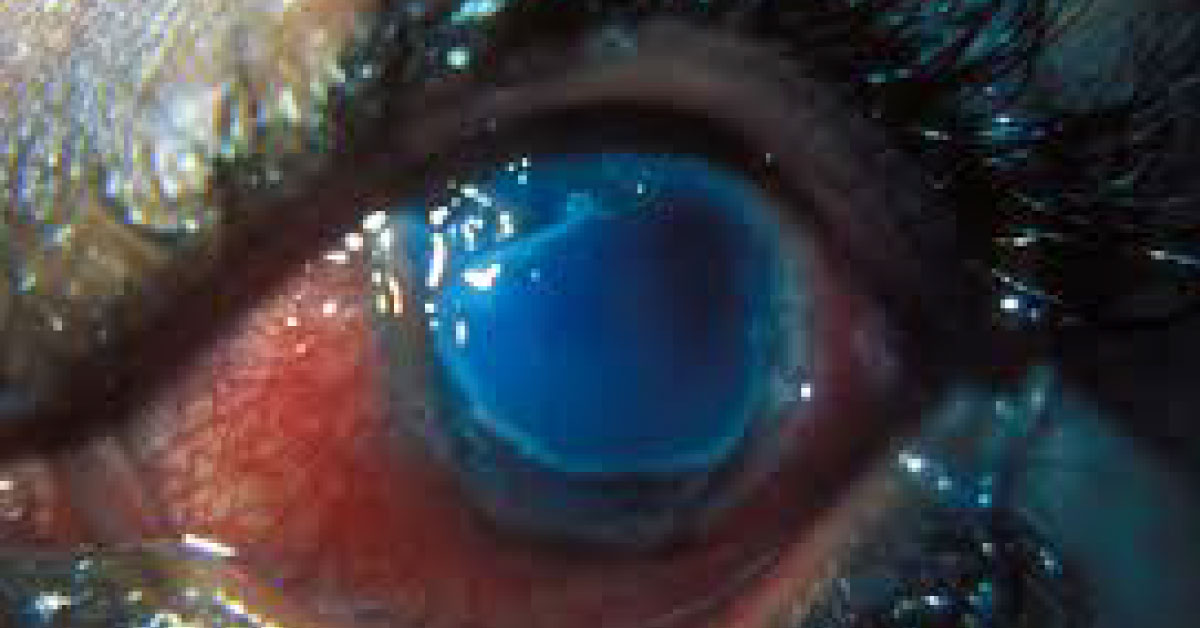 Brief Review On Mooren's Ulcer