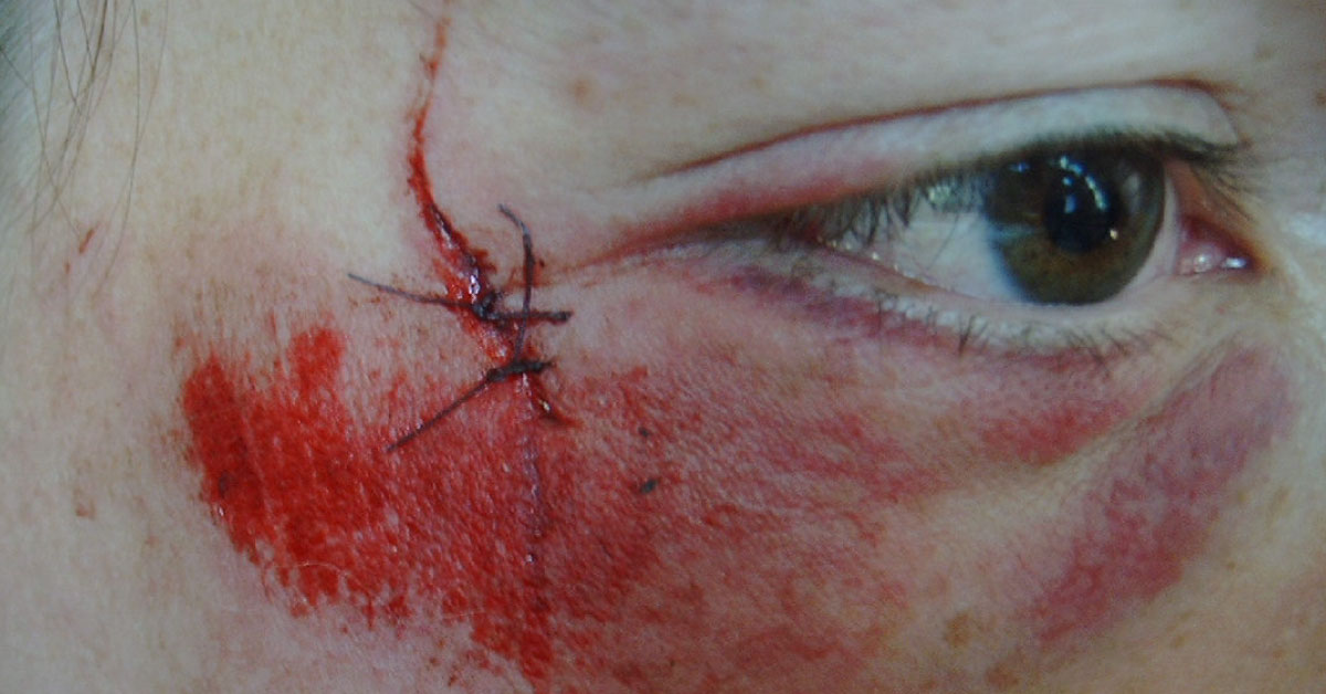 Brief Review On Ocular Manifestations Of Blunt Trauma