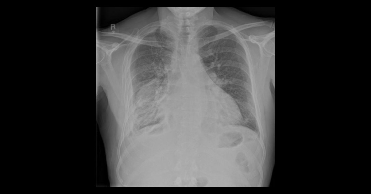 An Easily Mistaken Pulmonary Opacity