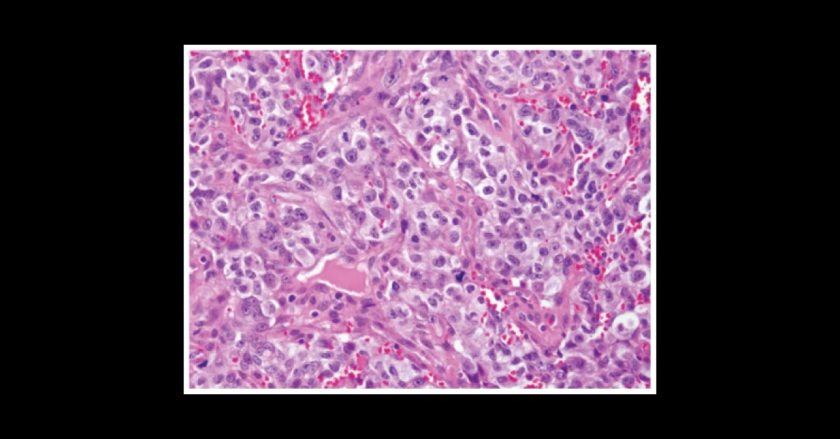 A Young Man with Persistent Cough and Back Pain