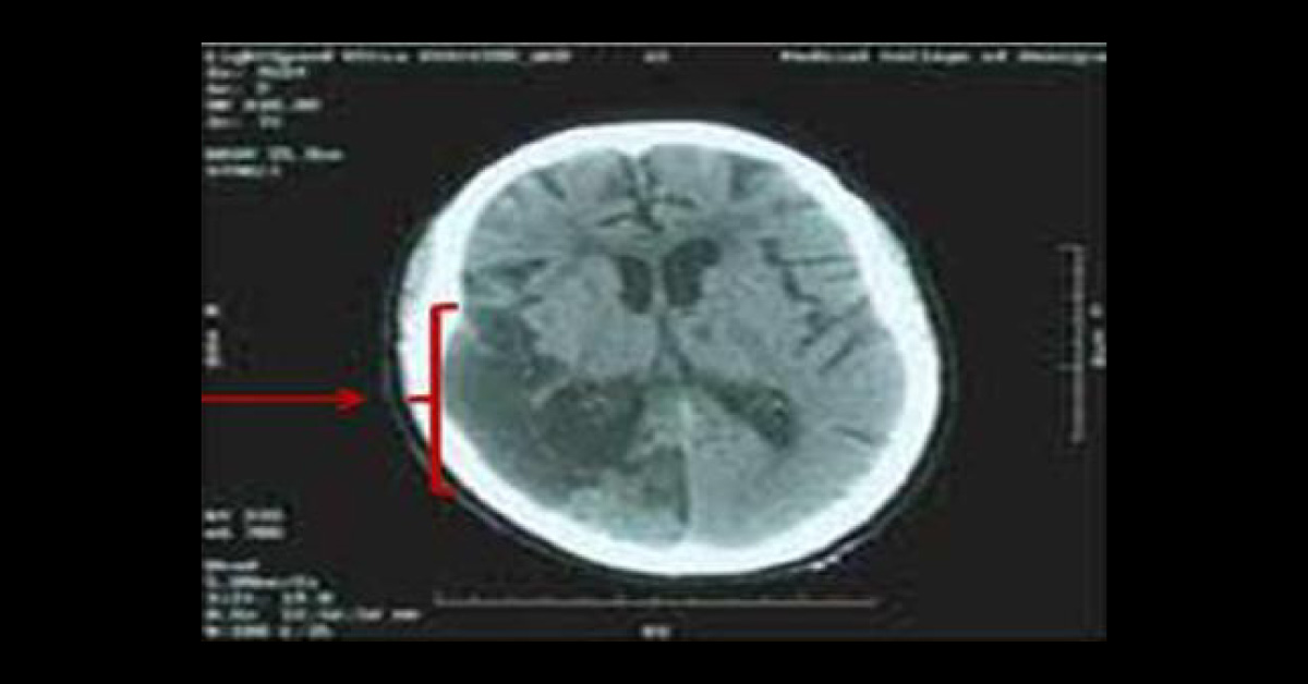 A Girl Child With Headache, Vomiting And Neurodeficit