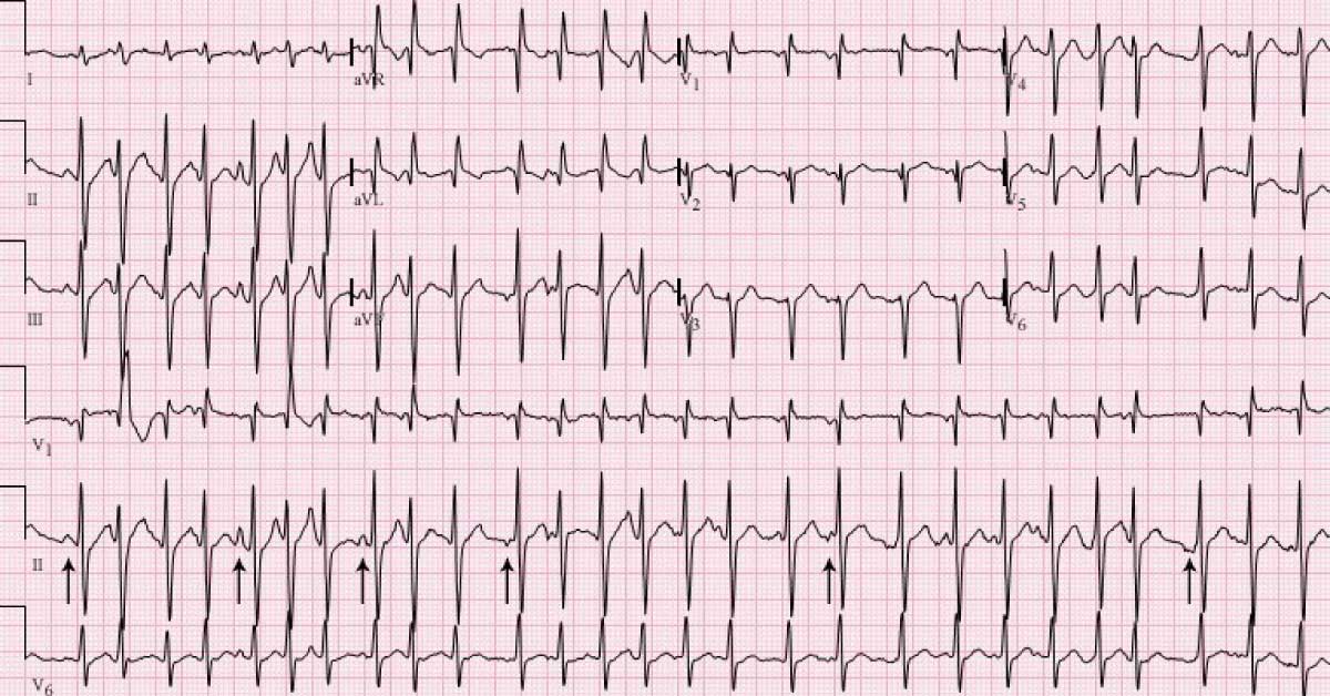 Interpret This ECG Of A COPD Patient