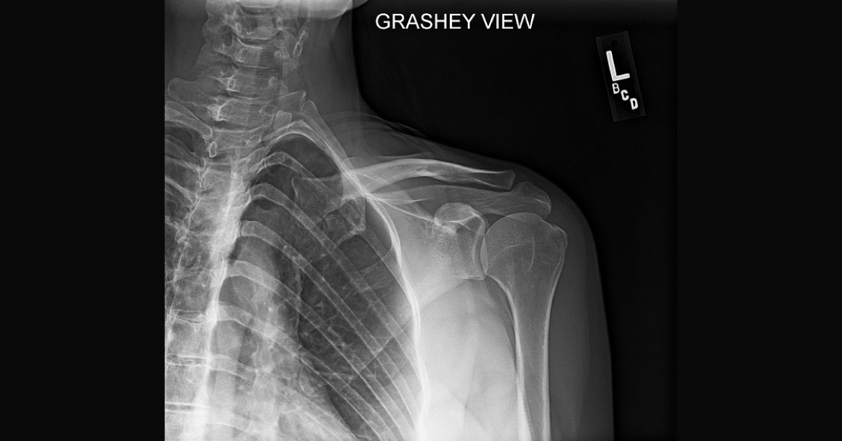 Recommend The Best Treatment for This Fracture