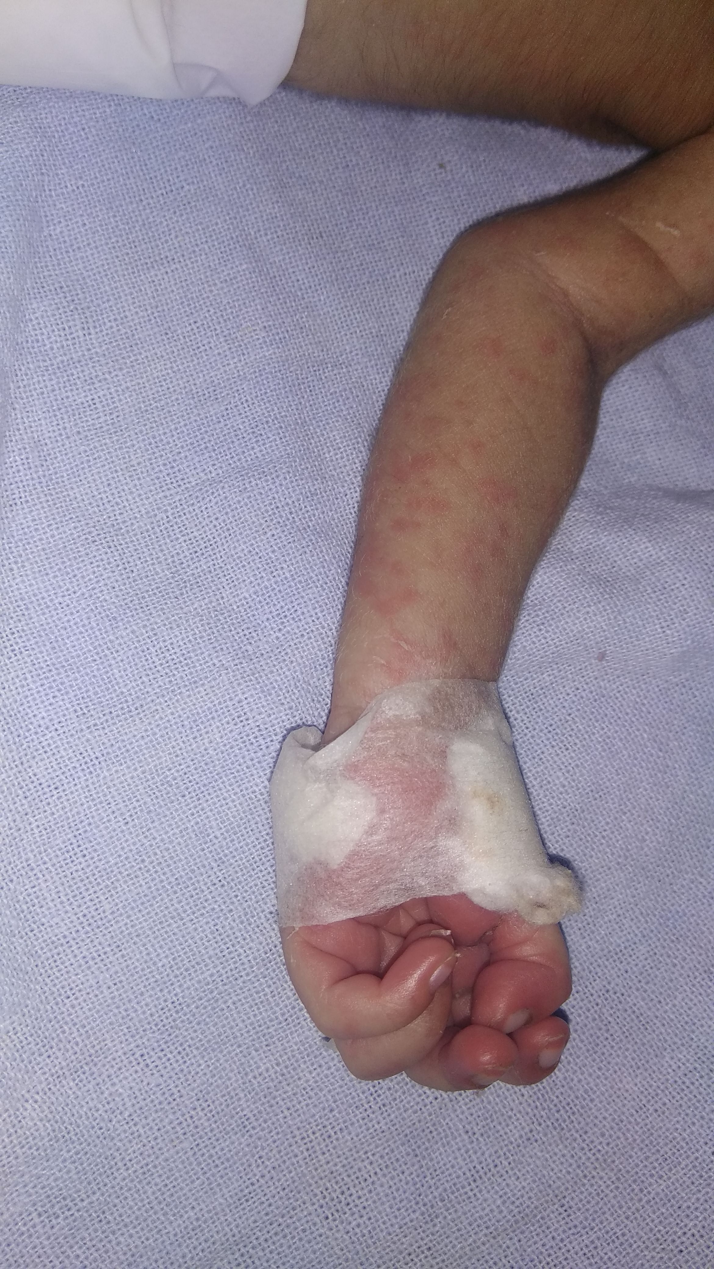 Diagnose The Rashes On Newborn's Body
