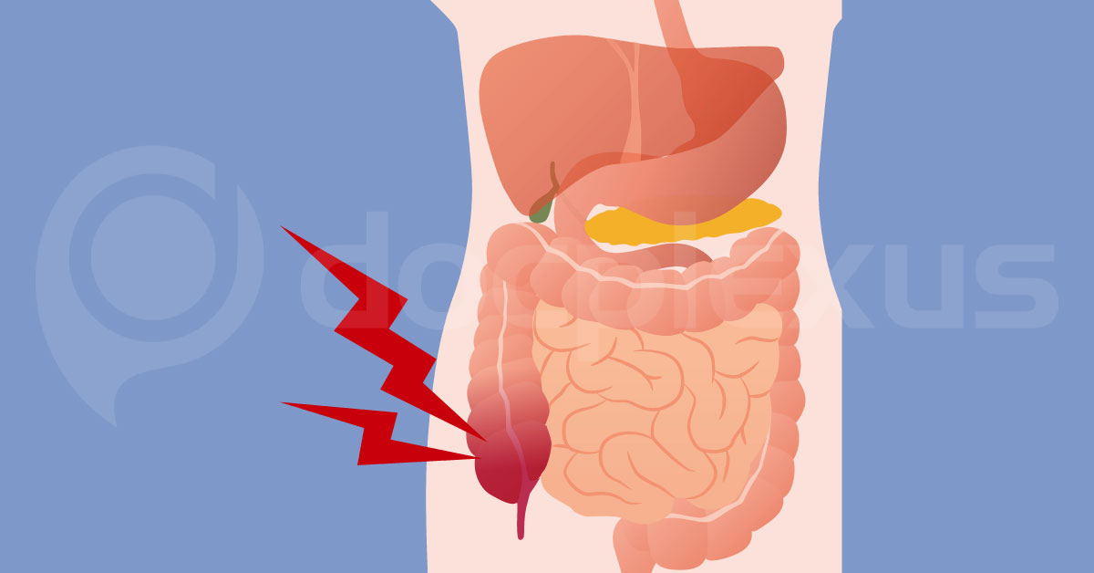 Identifying Effective Antibiotics For The Treatment Of Appendicitis