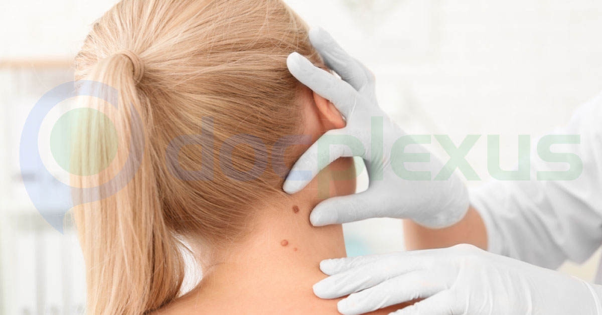 Recent Studies Reveal Increase In Occurrence Of Rare Skin Melanoma