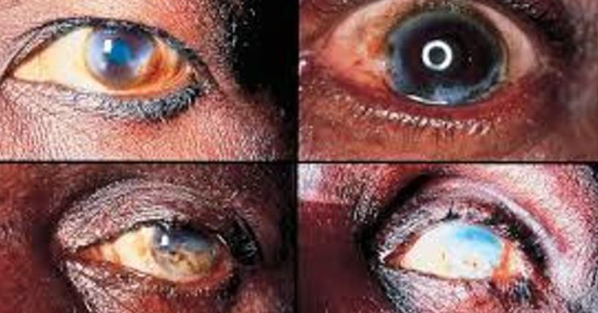Ocular Lesions In Trypanosomiasis: A Brief Review