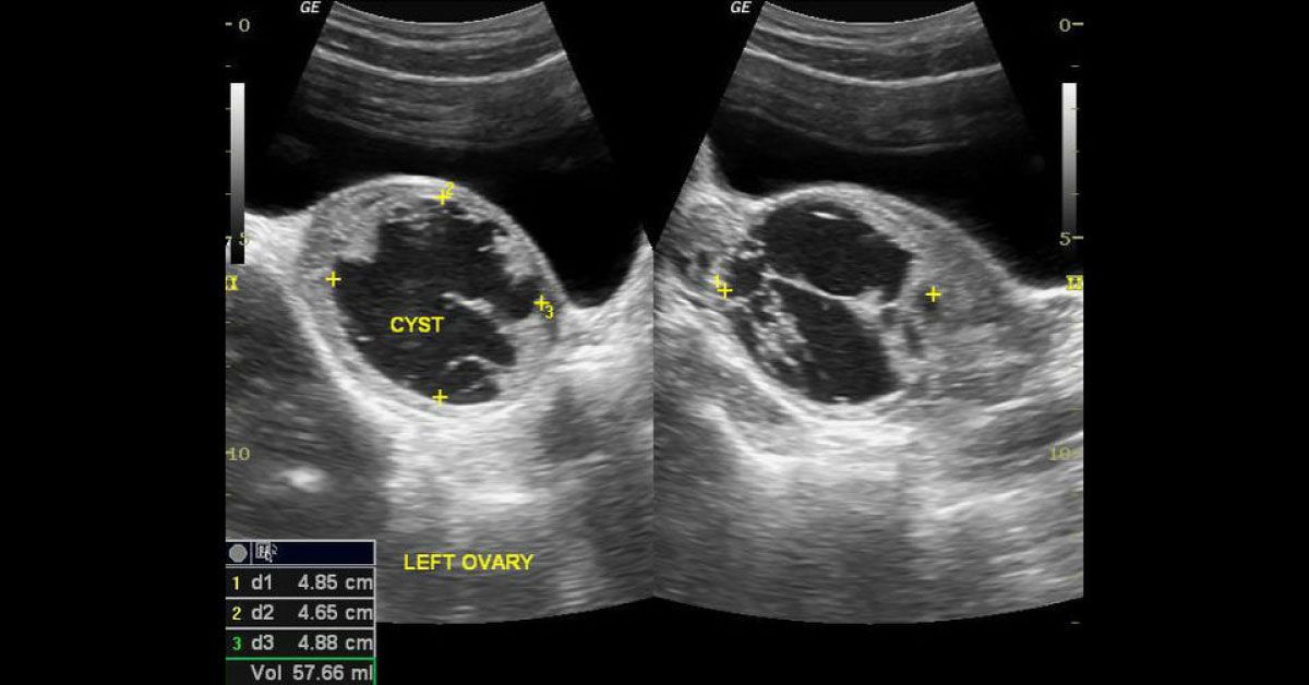 Female With Lower Abdominal Pain