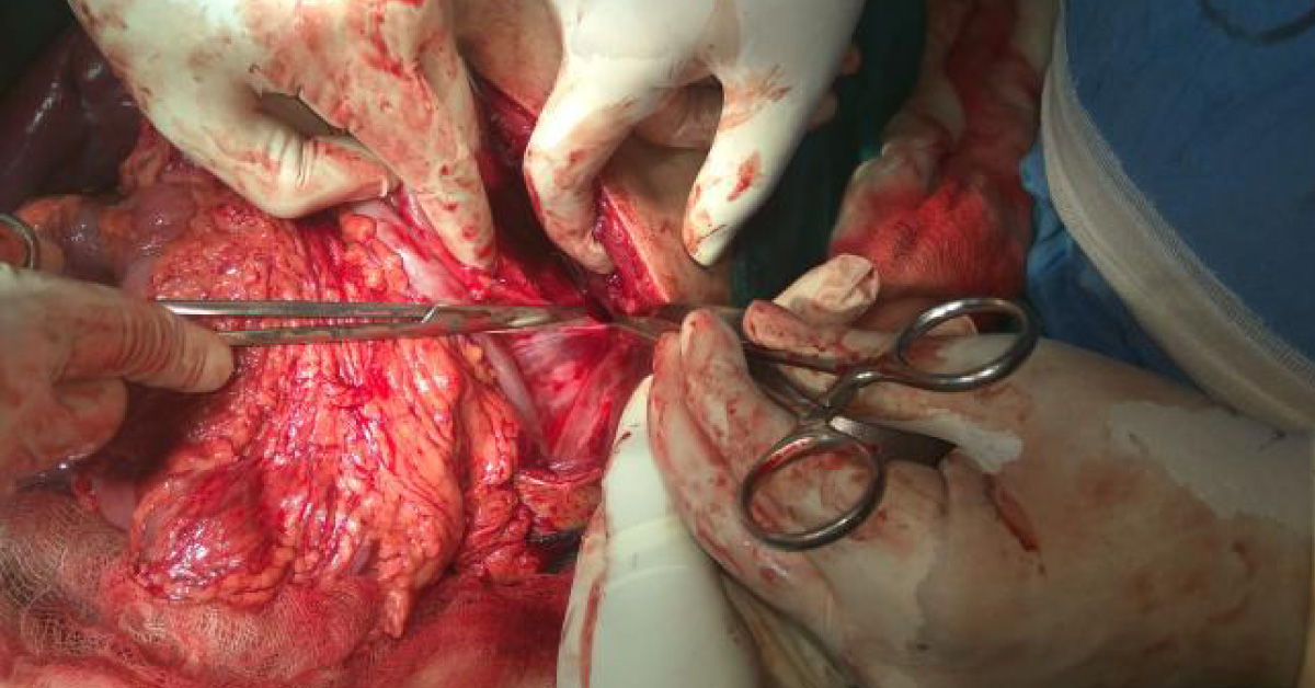 Vagal Nerve Freezing Will Kill Hunger And Reduce Obesity
