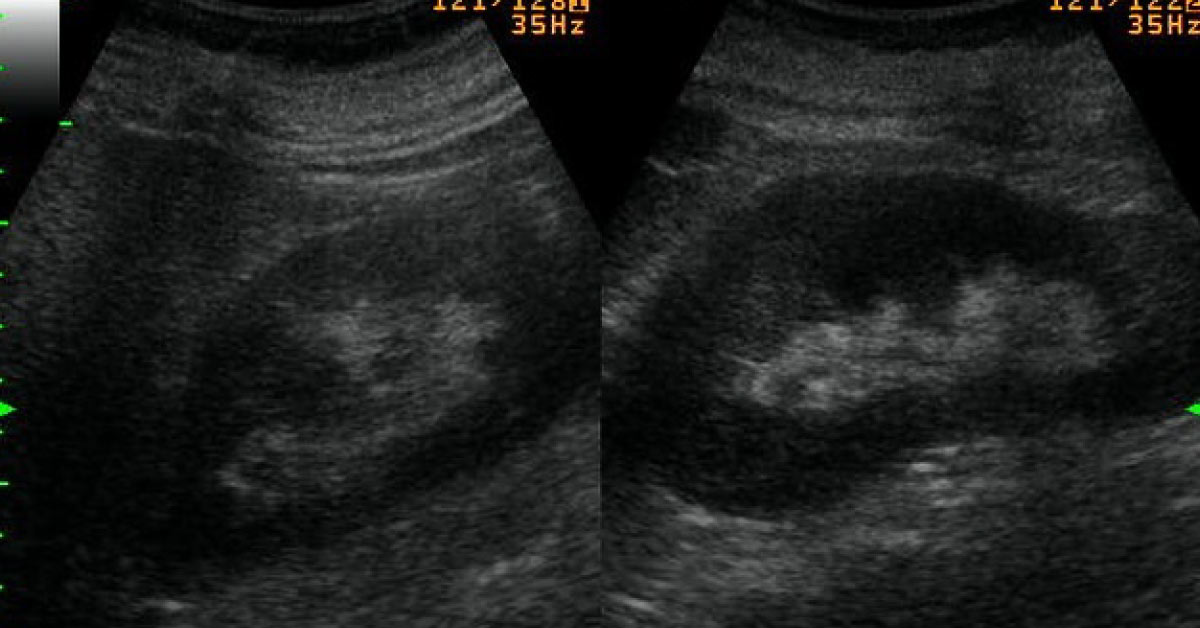 Case of a Female with Bilateral Flank Pain