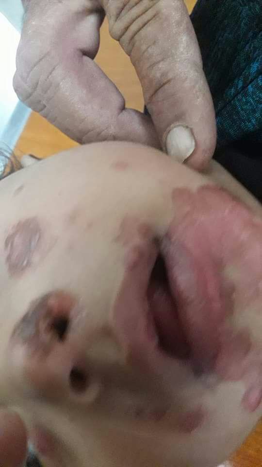 Probable Diagnosis Of Skin Lesions
