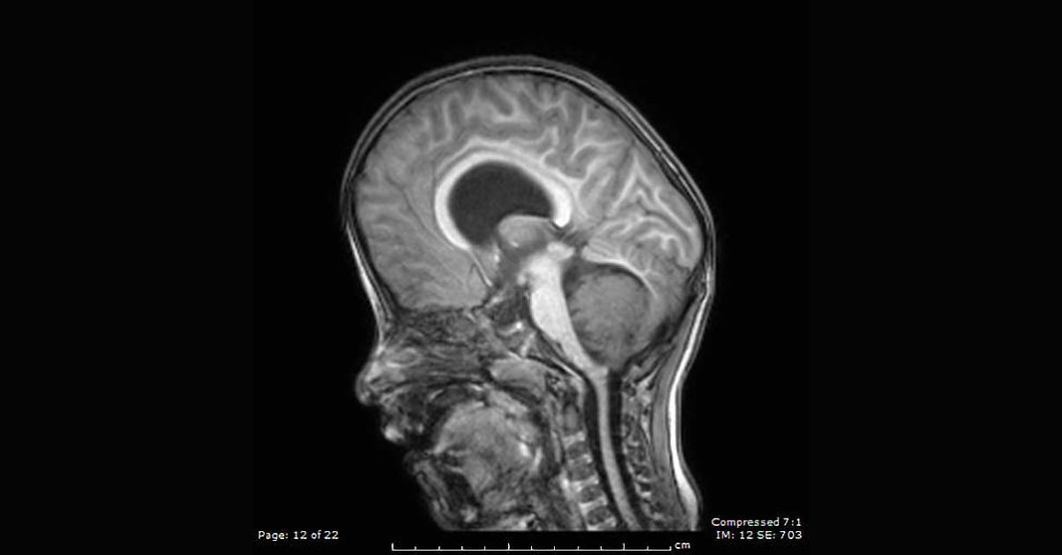Diagnose this Neurology Case