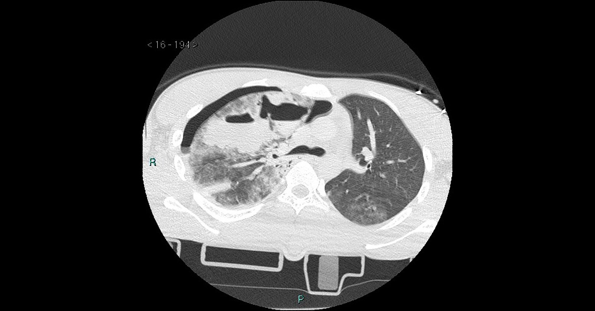 Case of a Man with a Reduced Breath Sound After Road Trauma