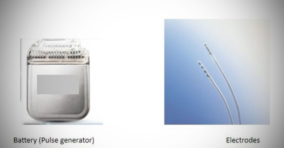Electrical Stimulation Of Brain: Brain Pacemaker