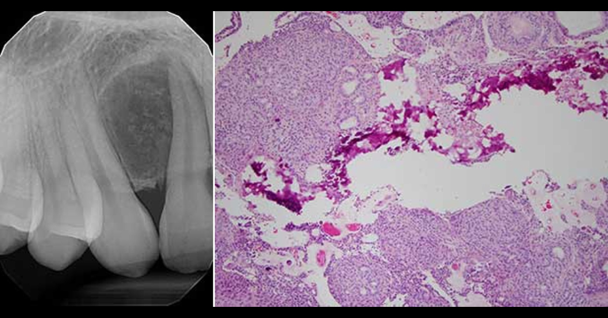 A Case of Lesion in the Right Maxilla