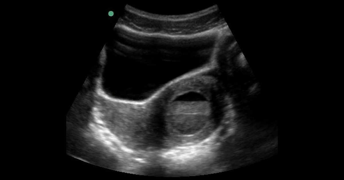 Female With Pain Associated With Periods