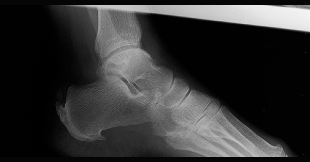Identify the Cause of a Bump on the Heel