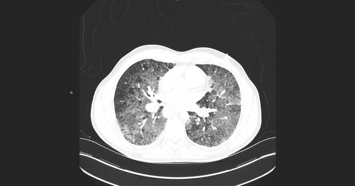 Interpret This MDCT Scan