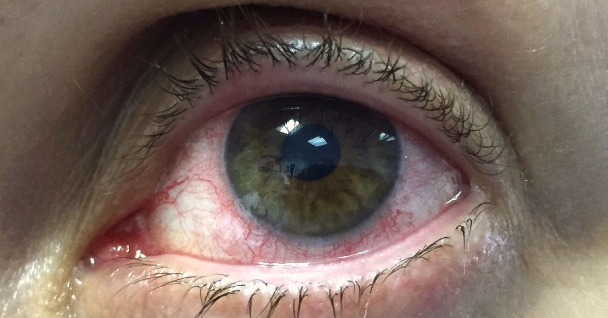 Brief Review Of A Mild Early Iritis