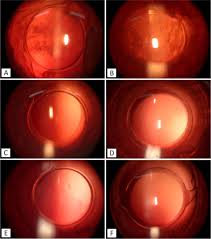 Brief Review On Management Of Post Capsule Opacification Past And Present