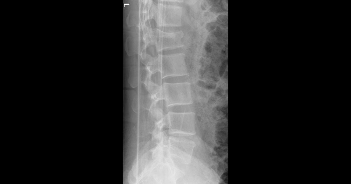 Male With Lumbar Pain
