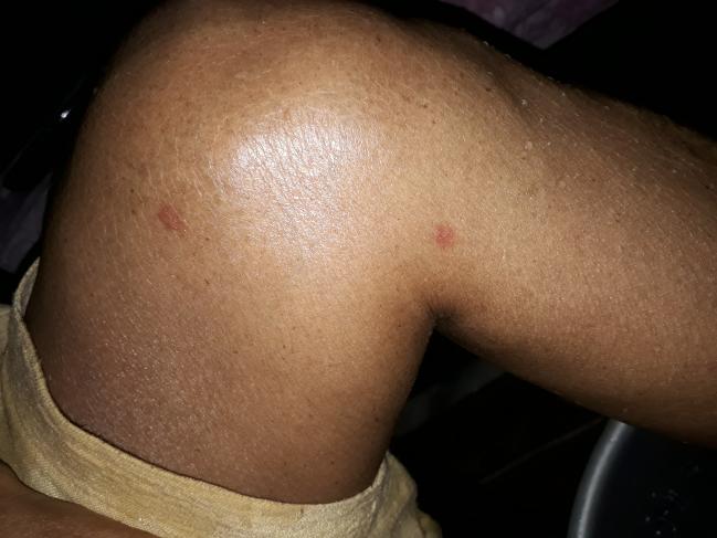 Can These Rashes Be Drug Induced?