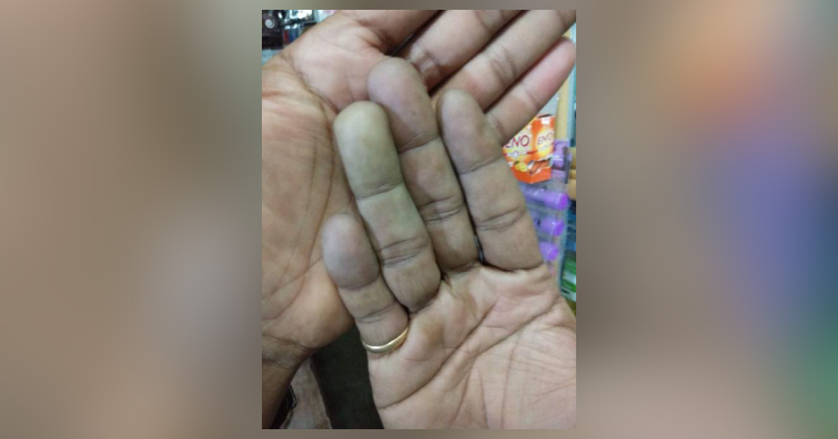 Bluish Discoloration Of Fingers 