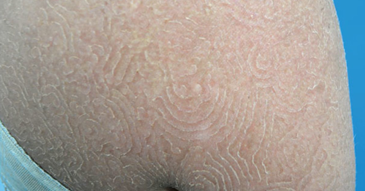 What are These Concentric Rashes?