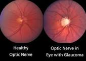 Surgical Procedures For Glaucoma: Past And Present