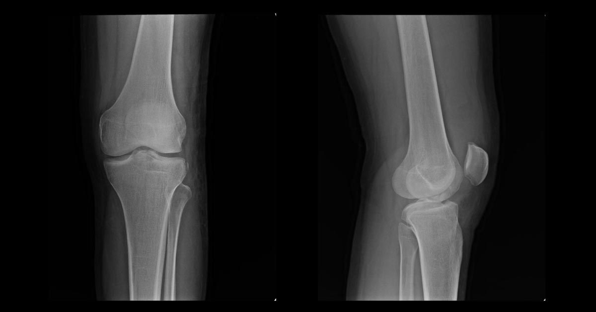 A Case Of Knee Trauma