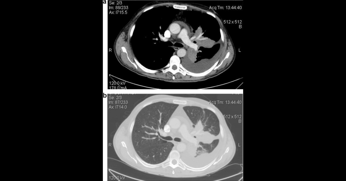 A Man with Fever and a Large Solid Mass in the Upper Left Lobe of His Lungs