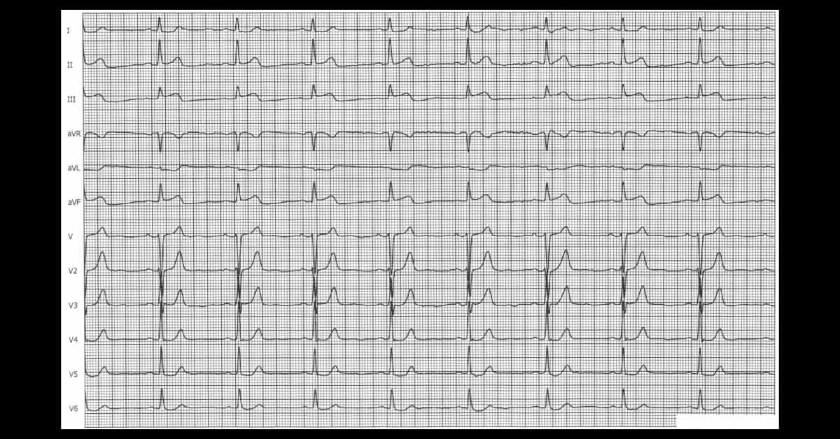 Identify the Cardiac Abnormality