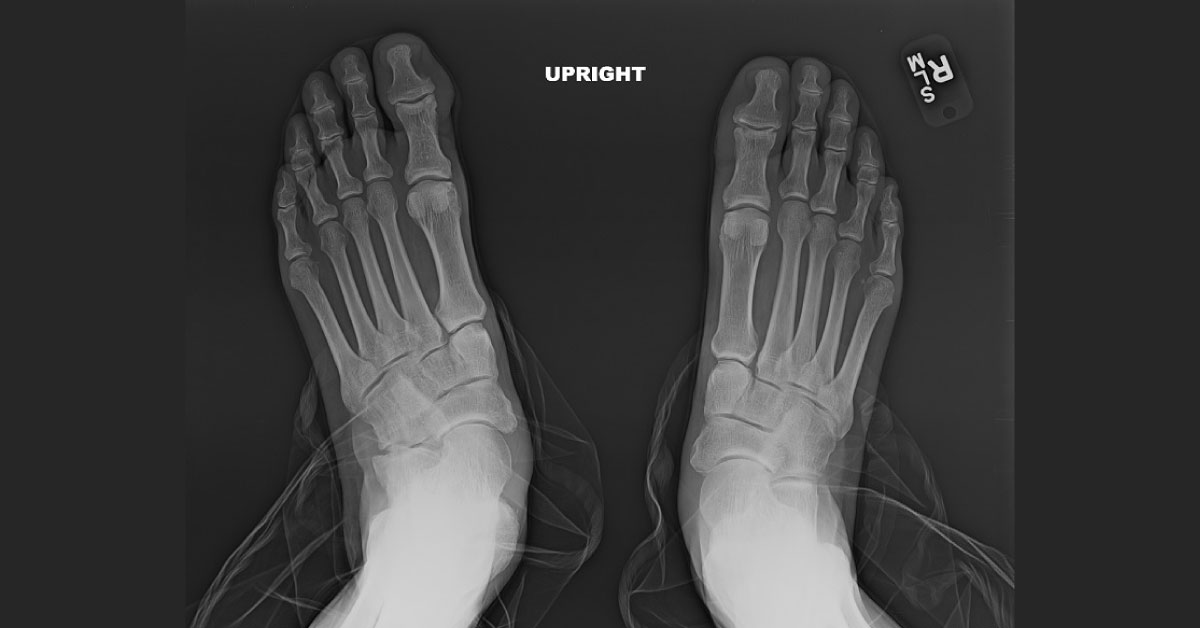 Case of Chronic Foot Pain and Deformity