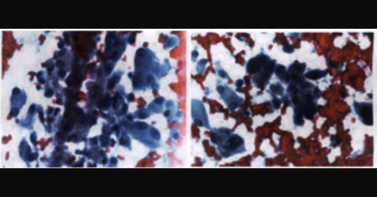 Molecular Testing Of A Thyroid Nodule In An Elderly Woman