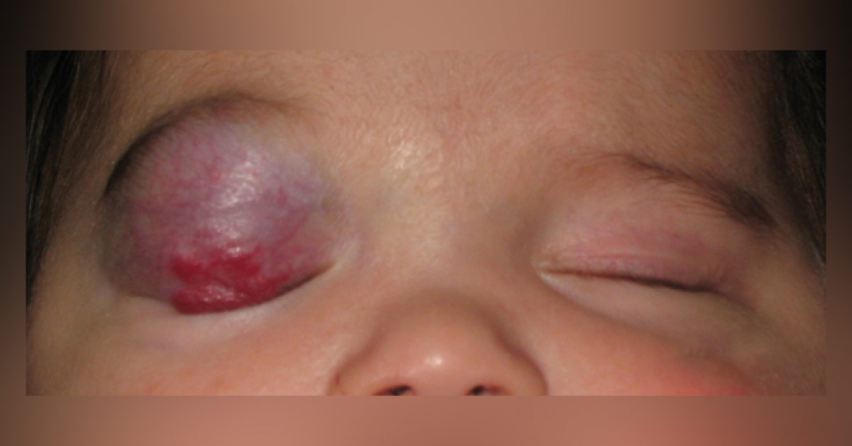 Diagnose the ophthalmic abnormality?