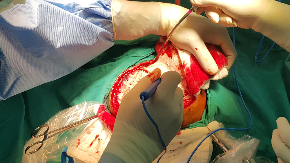 Different Methods And Technical Considerations Of Decompressive Craniectomy In The Treatment Of Traumatic Brain Injury: A Review