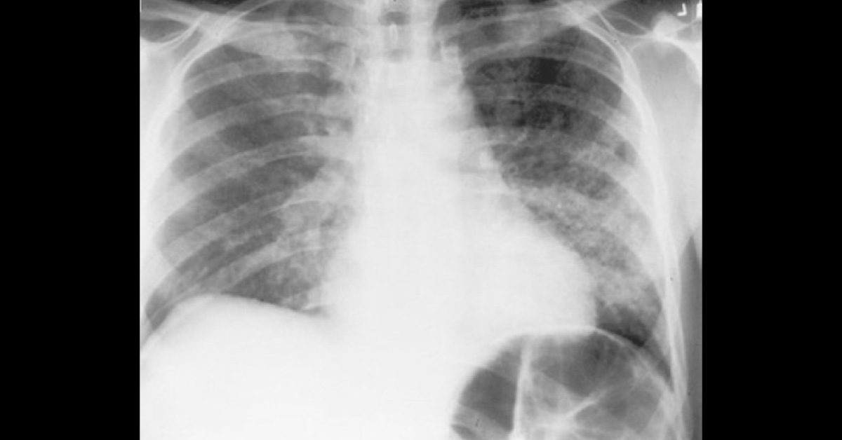 Fever and Dyspnea with a History of HIV