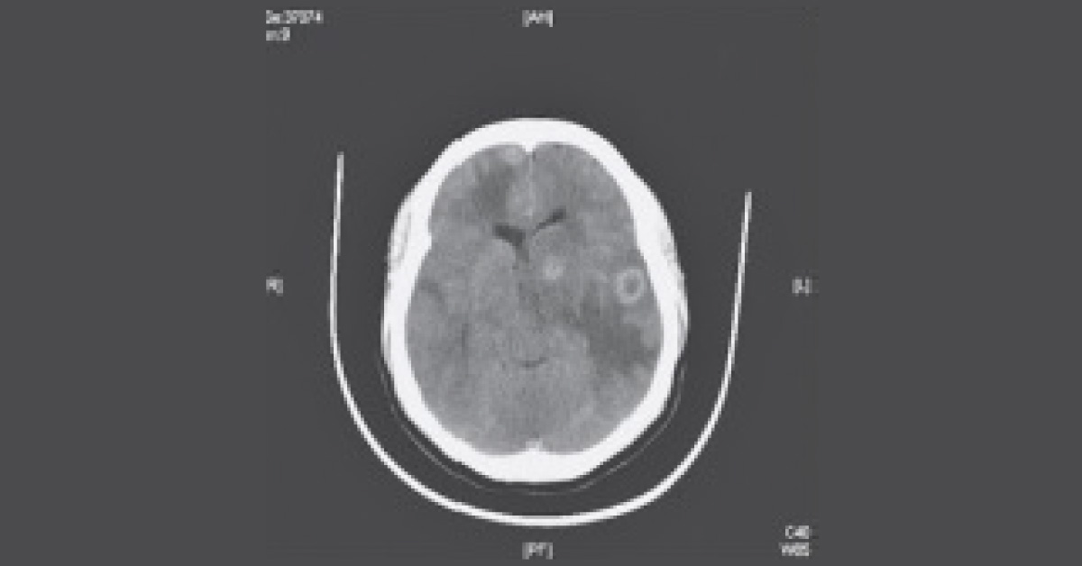 A Case Of Headache And Confusion