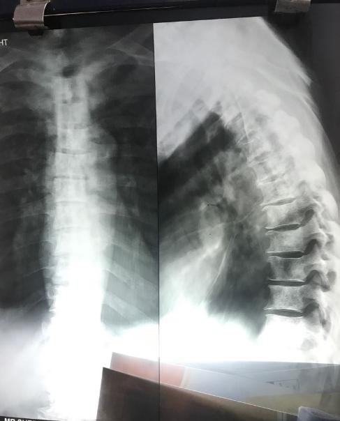 Are These Metastatic Or Osteoporosis Lesions?