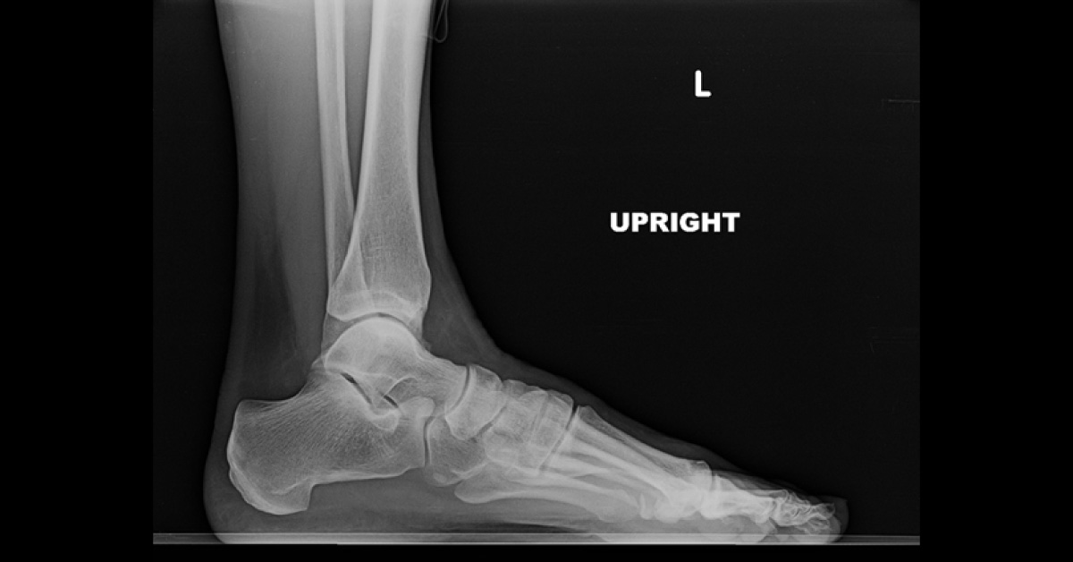 Solve This Case Of Increased Forefoot Pain