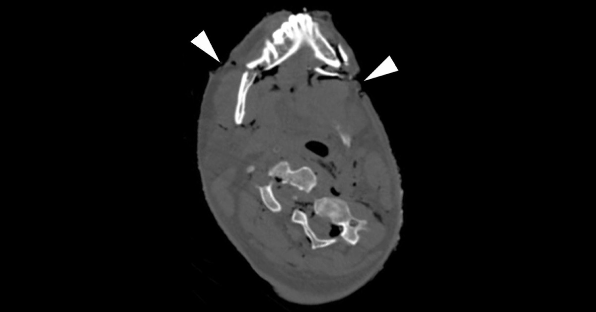 Blunt Trauma in an Accident Victim