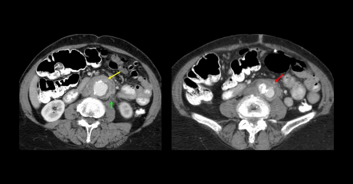 Chronic Back Pain In 61 Year-Old