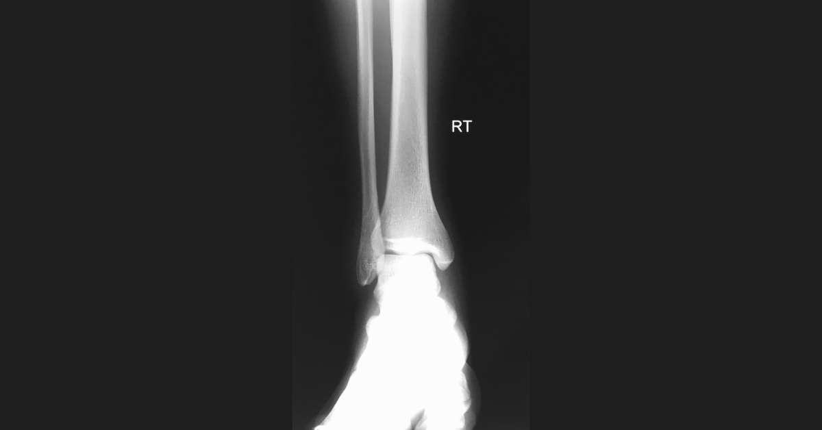 Male With Severe Ankle Pain