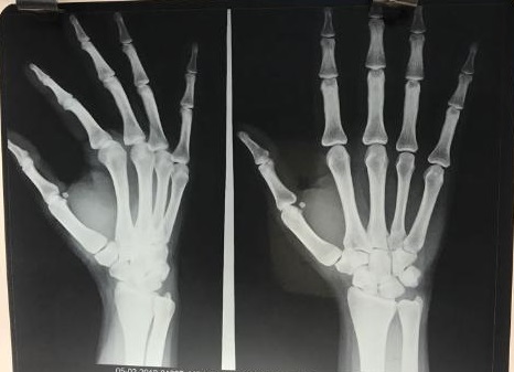 Why Is Pain At Middle Finger Metacarpo-Phalangeal Joint?