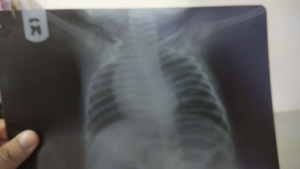 What Is Cause Of Fused Umbilicus?