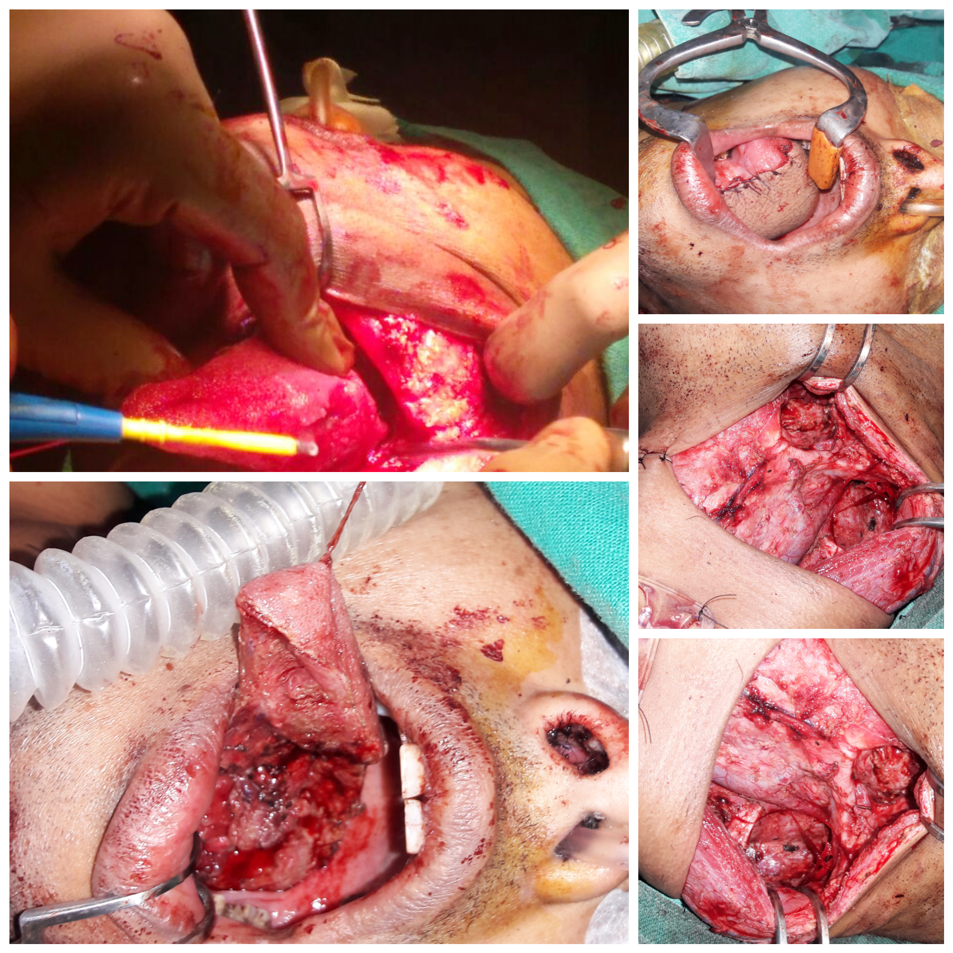 Carcinoma Tongue