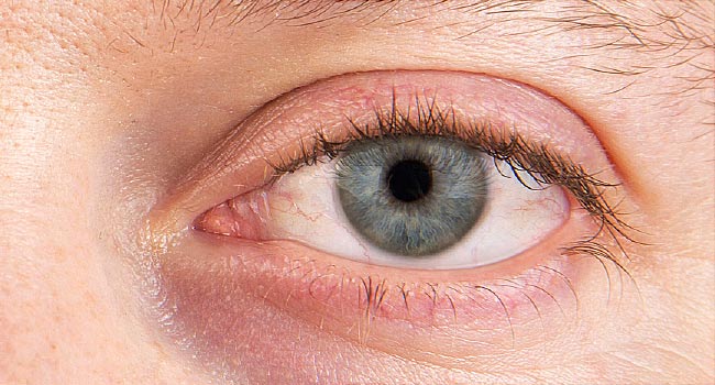 Brief Review On  Causes Of Dry Eye