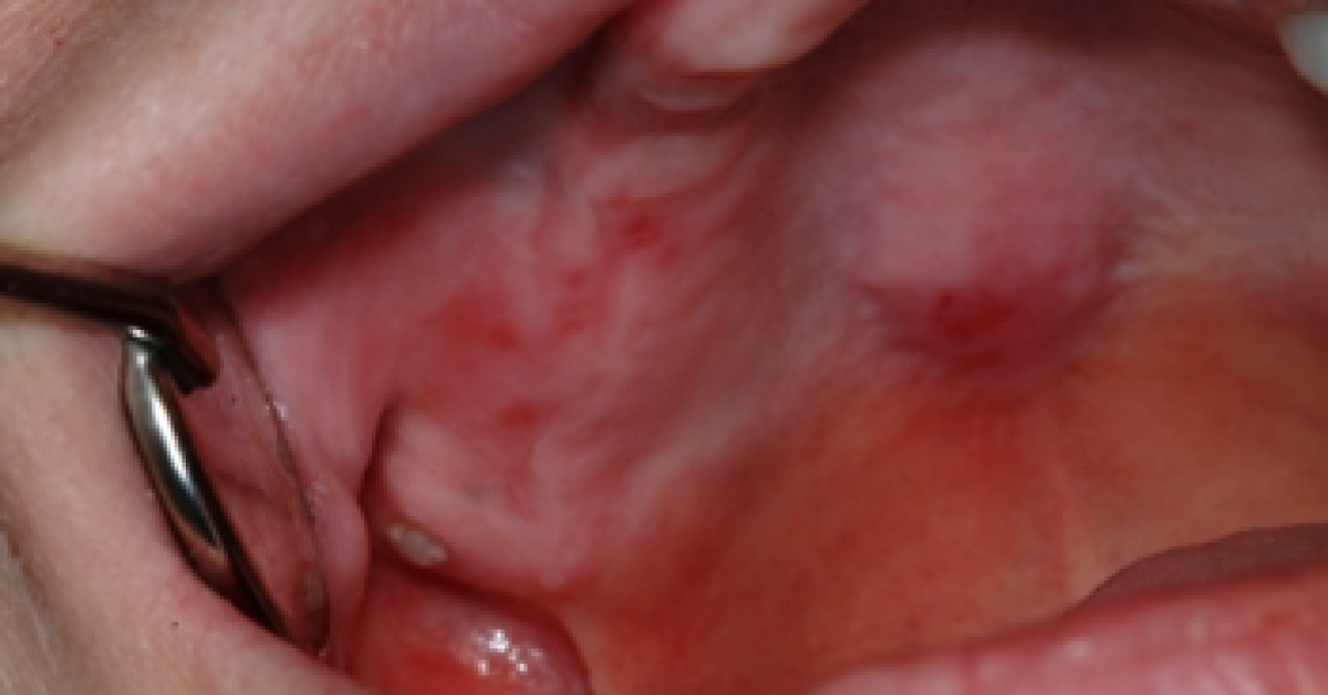 Multiple Oral Ulcerations And Skin Rash